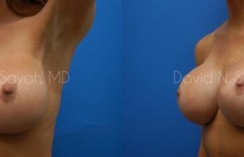 Breast Augmentation Before and After | Sayah Institute