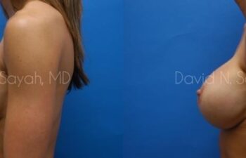Breast Augmentation Before and After | Sayah Institute