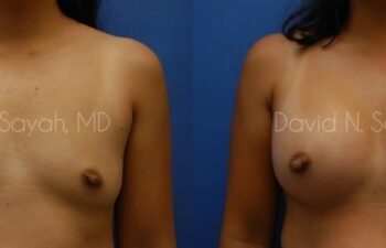Breast Augmentation Before and After | Sayah Institute