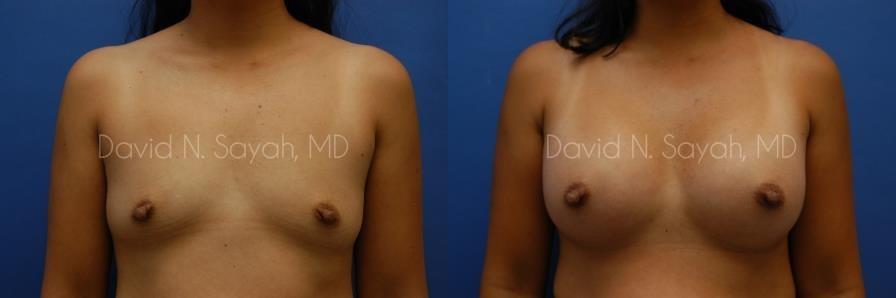 Breast Augmentation Before and After | Sayah Institute