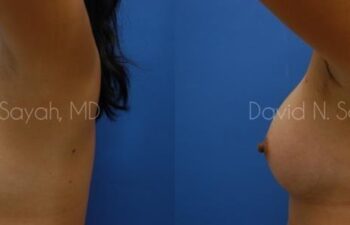 Breast Augmentation Before and After | Sayah Institute