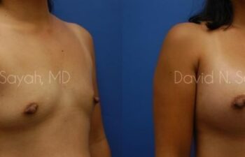 Breast Augmentation Before and After | Sayah Institute