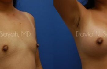 Breast Augmentation Before and After | Sayah Institute