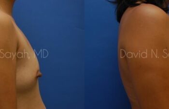 Breast Augmentation Before and After | Sayah Institute