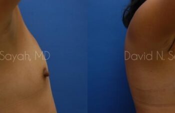 Breast Augmentation Before and After | Sayah Institute
