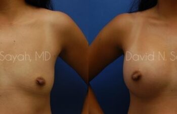 Breast Augmentation Before and After | Sayah Institute