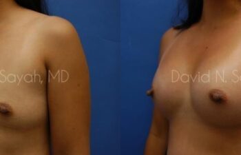 Breast Augmentation Before and After | Sayah Institute