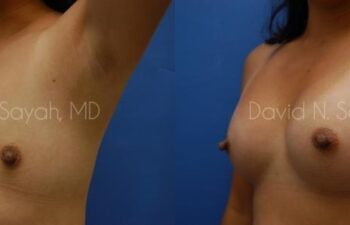 Breast Augmentation Before and After | Sayah Institute