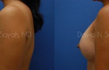 Breast Augmentation Before and After | Sayah Institute