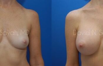 Breast Augmentation Before and After | Sayah Institute