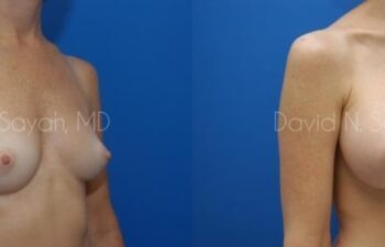 Breast Augmentation Before and After | Sayah Institute