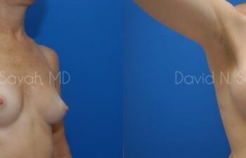 Breast Augmentation Before and After | Sayah Institute