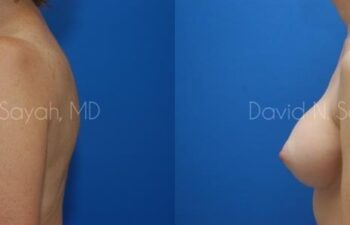 Breast Augmentation Before and After | Sayah Institute