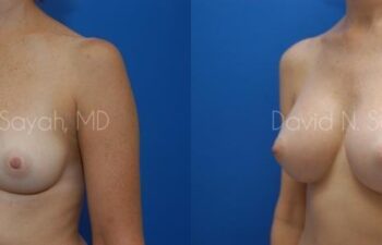 Breast Augmentation Before and After | Sayah Institute