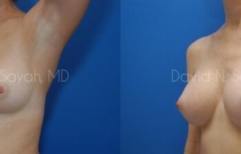 Breast Augmentation Before and After | Sayah Institute