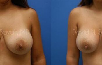 Breast Implant Exchange Before and After | Sayah Institute