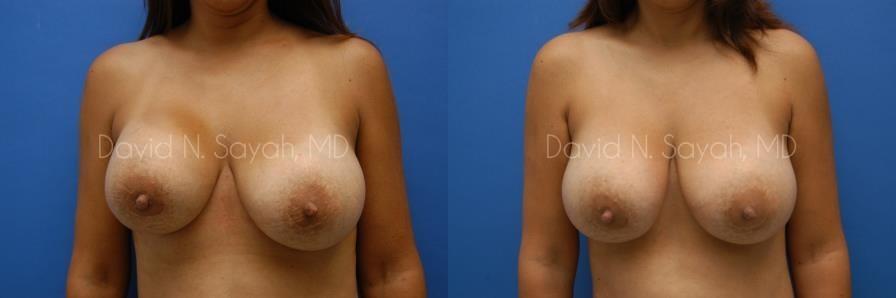 Breast Implant Exchange Before and After | Sayah Institute