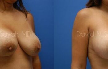 Breast Implant Exchange Before and After | Sayah Institute