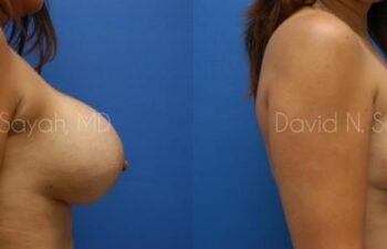 Breast Implant Exchange Before and After | Sayah Institute