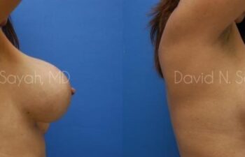 Breast Implant Exchange Before and After | Sayah Institute