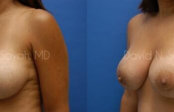 Breast Implant Exchange Before and After | Sayah Institute