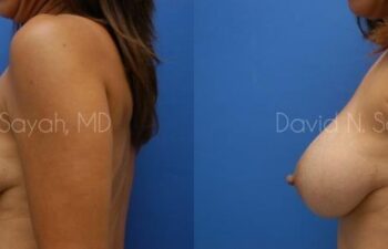 Breast Implant Exchange Before and After | Sayah Institute