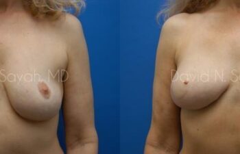 Breast Reconstruction Before and After | Sayah Institute