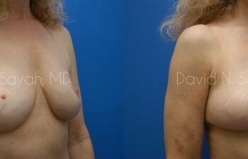 Breast Reconstruction Before and After | Sayah Institute