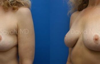 Breast Reconstruction Before and After | Sayah Institute