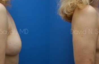 Breast Reconstruction Before and After | Sayah Institute