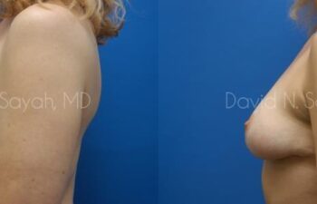 Breast Reconstruction Before and After | Sayah Institute