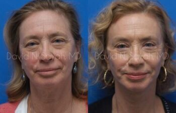 Brow Lift Before and After | Sayah Institute