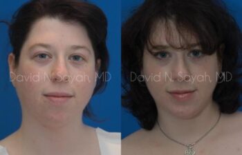 Chin Implant Before and After | Sayah Institute