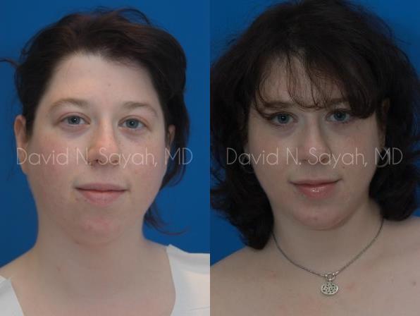 Chin Implant Before and After | Sayah Institute