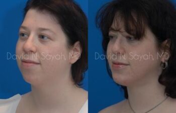 Chin Implant Before and After | Sayah Institute