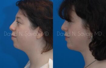 Chin Implant Before and After | Sayah Institute