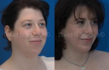 Chin Implant Before and After | Sayah Institute