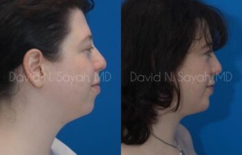 Chin Implant Before and After | Sayah Institute