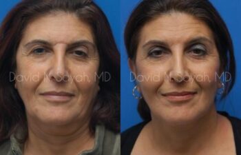 Facelift Before and After | Sayah Institute