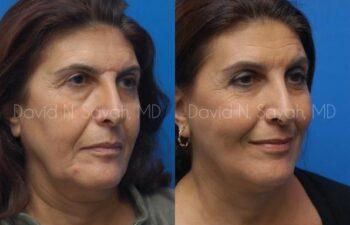 Facelift Before and After | Sayah Institute