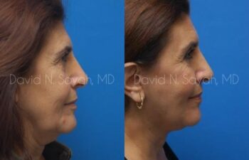 Facelift Before and After | Sayah Institute