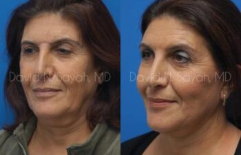 Facelift Before and After | Sayah Institute