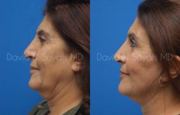 Facelift Before and After | Sayah Institute