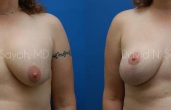 Breast Augmentation And Mastopexy Before and After | Sayah Institute