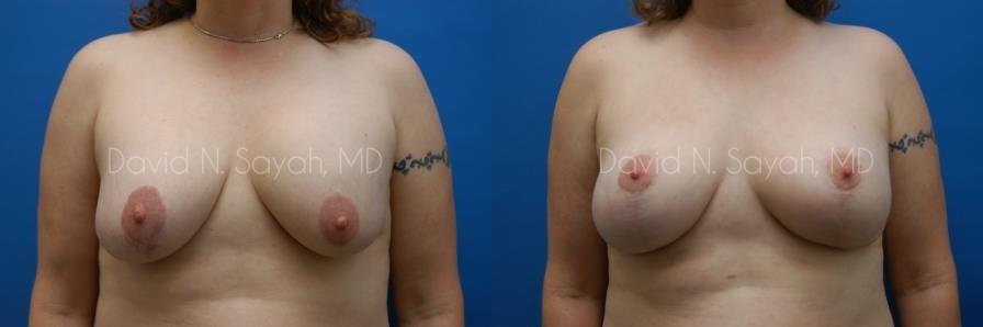 Breast Augmentation And Mastopexy Before and After | Sayah Institute