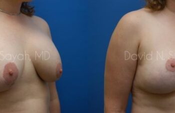 Breast Augmentation And Mastopexy Before and After | Sayah Institute
