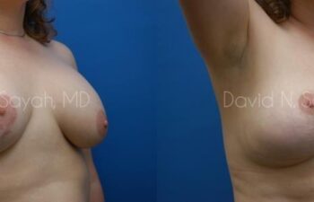 Breast Augmentation And Mastopexy Before and After | Sayah Institute