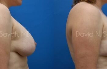 Breast Augmentation And Mastopexy Before and After | Sayah Institute