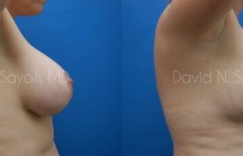 Breast Augmentation And Mastopexy Before and After | Sayah Institute