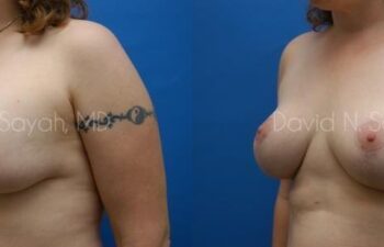 Breast Augmentation And Mastopexy Before and After | Sayah Institute